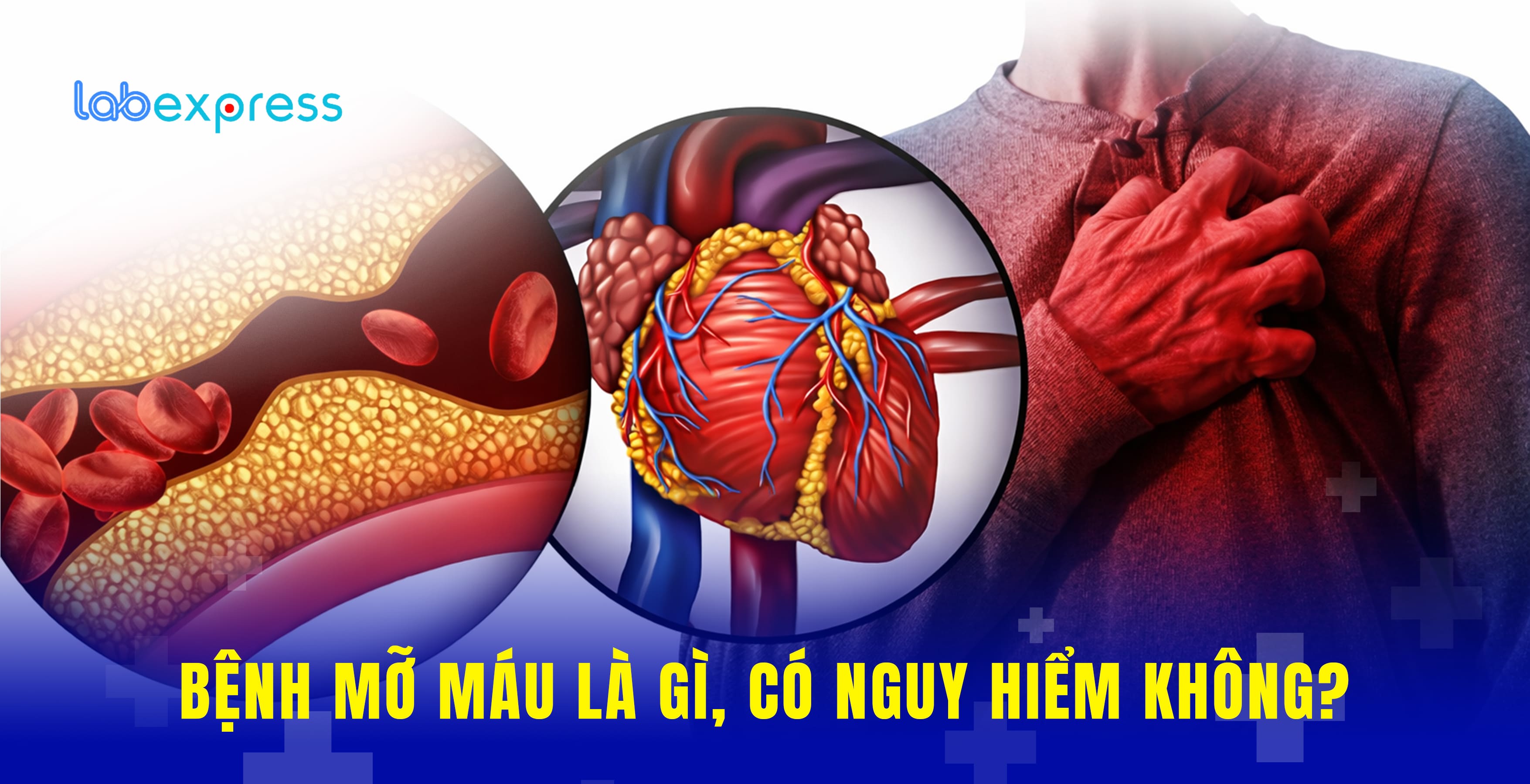 BỆNH MỠ MÁU LÀ GÌ, CÓ NGUY HIỂM KHÔNG?